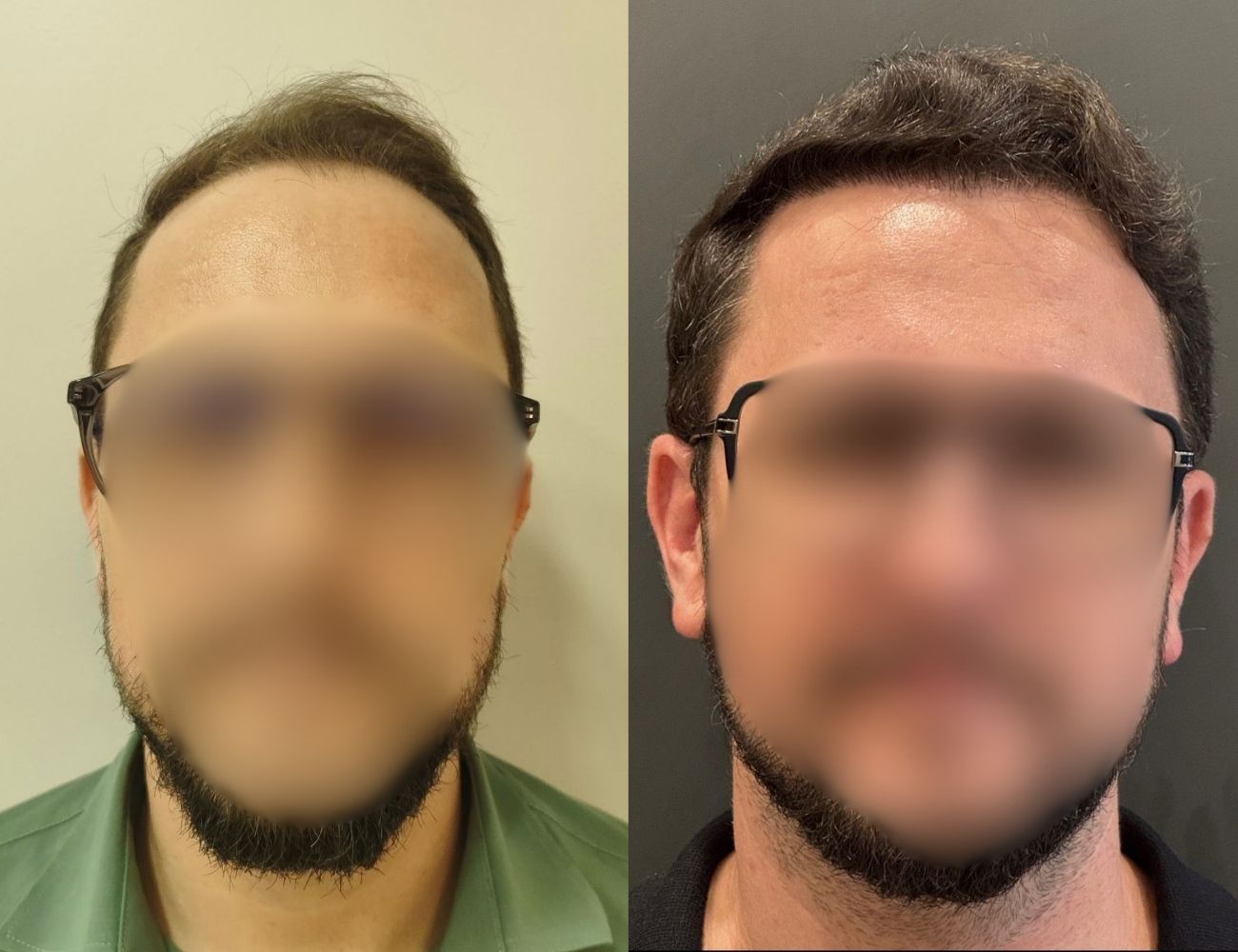 Antes e depois - Recuperação de entradas