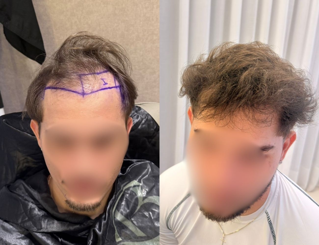 Antes e depois - Cobertura de topo e coroa