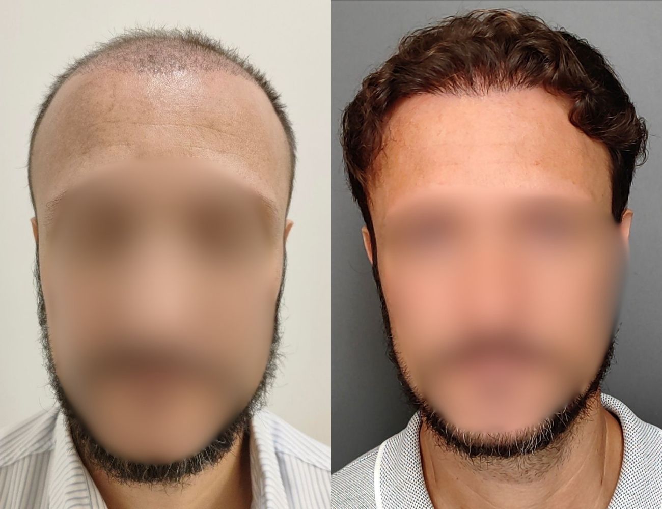 Antes e depois - Implante capilar completo
