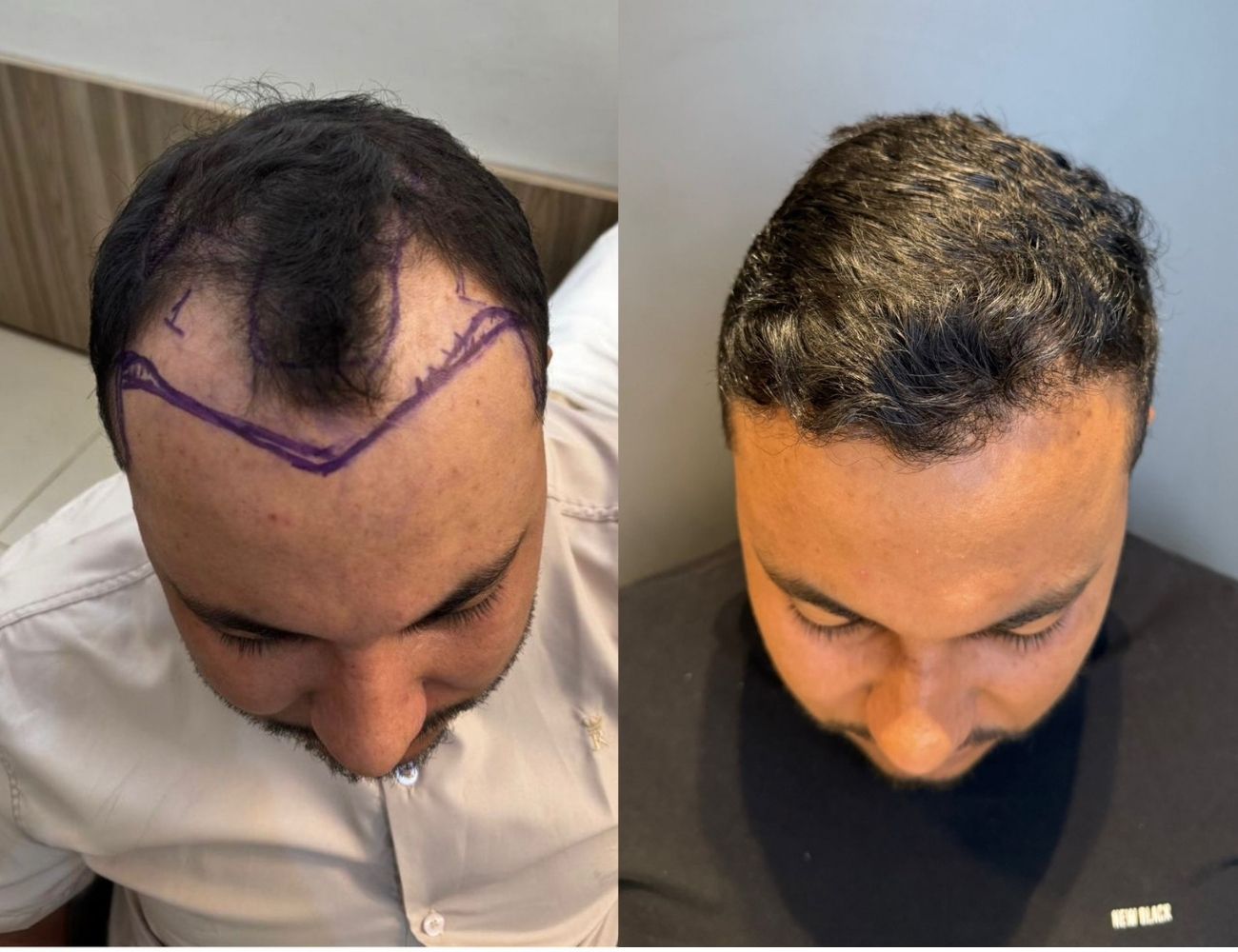 Antes e depois - Densidade no topo