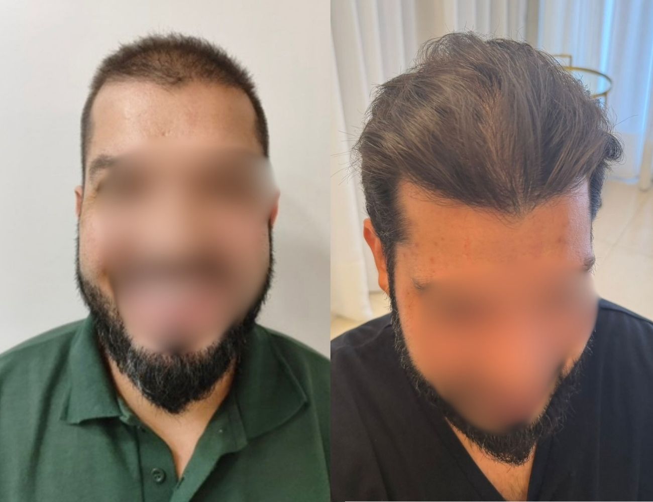 Antes e depois - Resultado natural e definido